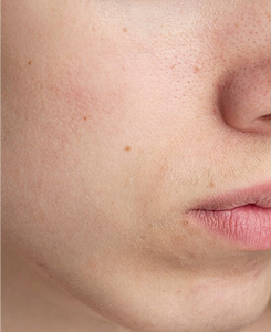 Dry Skin